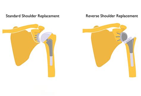 reverse total shoulder orthobullets|Reverse Total Shoulder Arthroplasty .
